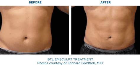 pacific beach mscuplt|Top EMSCULPT NEO Provider San Diego, CA in .